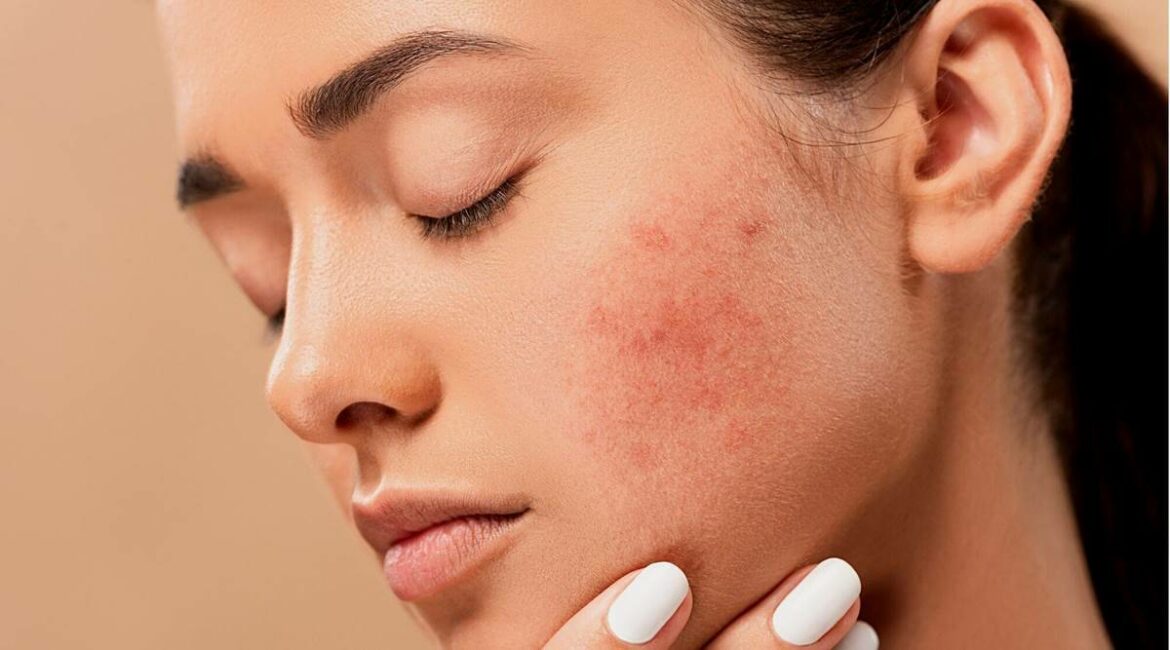 Comment faire partir l'acné naturellement