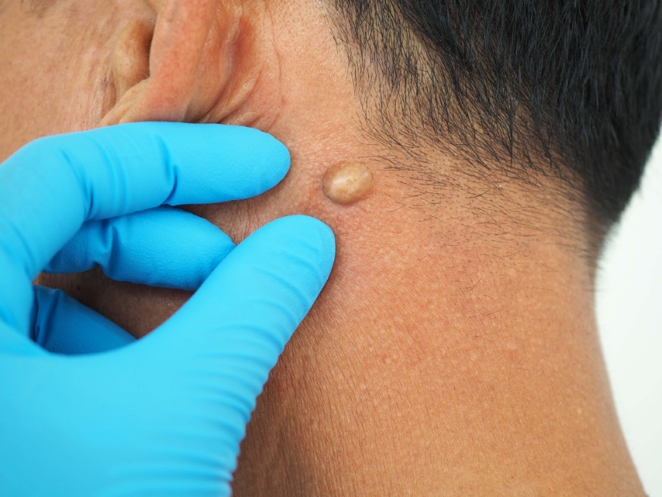 lipome cou boules de graisse